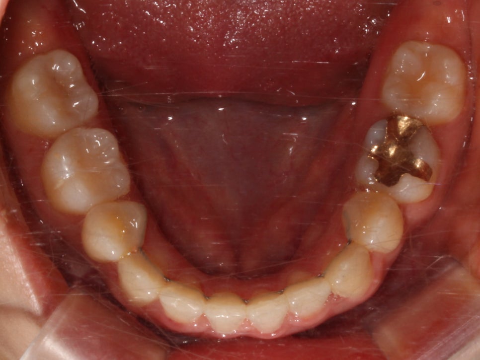 돌출입 탈출기! 덧니 교정도 문제없어! by.투디치과(2D치과) 관련 이미지 13