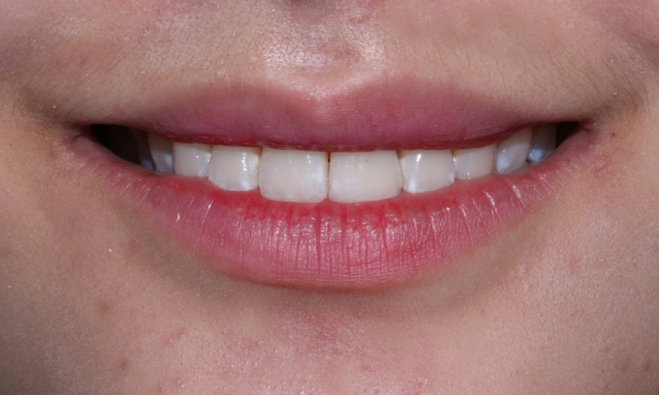 반포치과 뻐드렁니교정 방법은? 관련 이미지 8