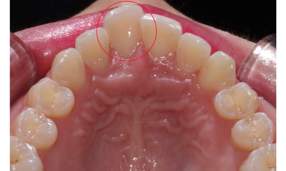 반포치과 뻐드렁니교정 방법은? 관련 이미지 5