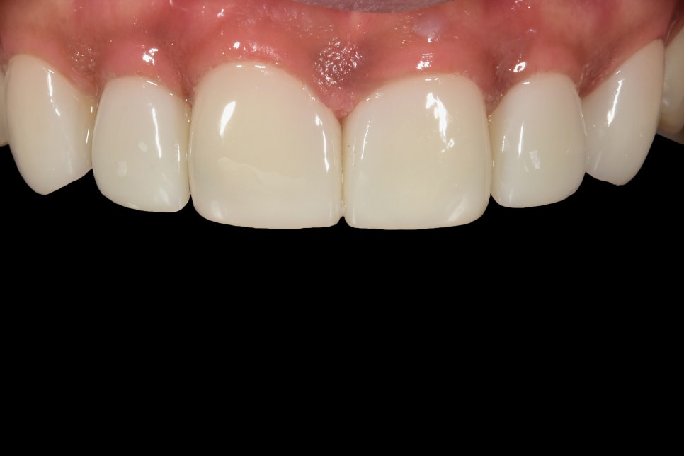 연예인라미네이트 무삭제로 잘하는 2D치과 관련 이미지 14