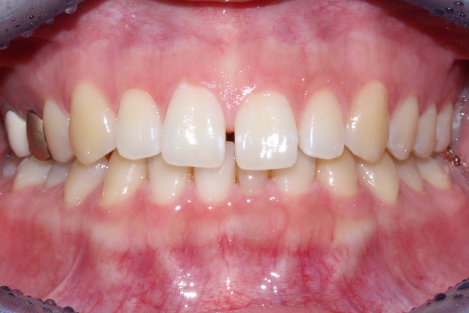 벌어진앞니 치간이개 공간 삭제하기! 관련 이미지 3