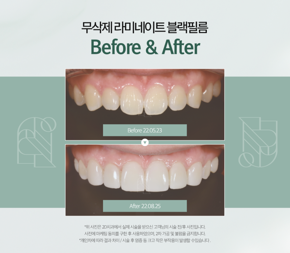 무삭제라미네이트후기 치아미백비용 환한 미소로 자신감 있게! 관련 이미지 7