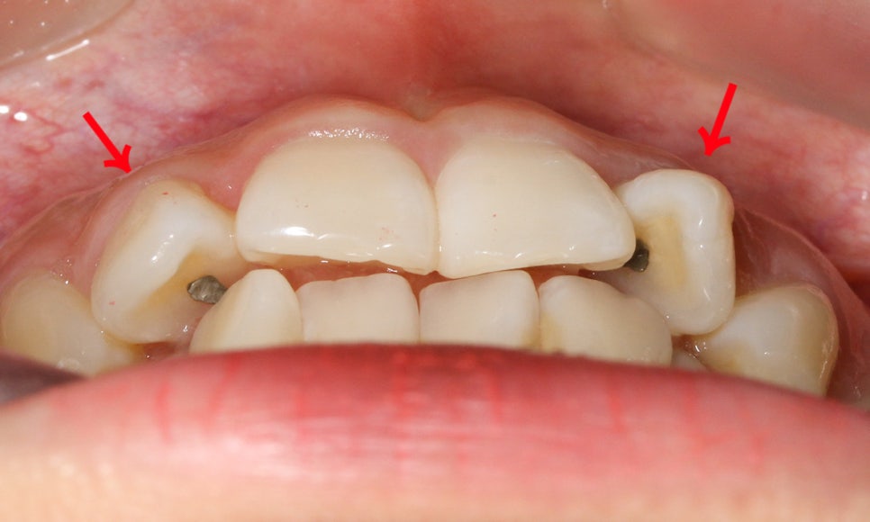 세라믹교정 앞니틀어짐 교정 사례 관련 이미지 3