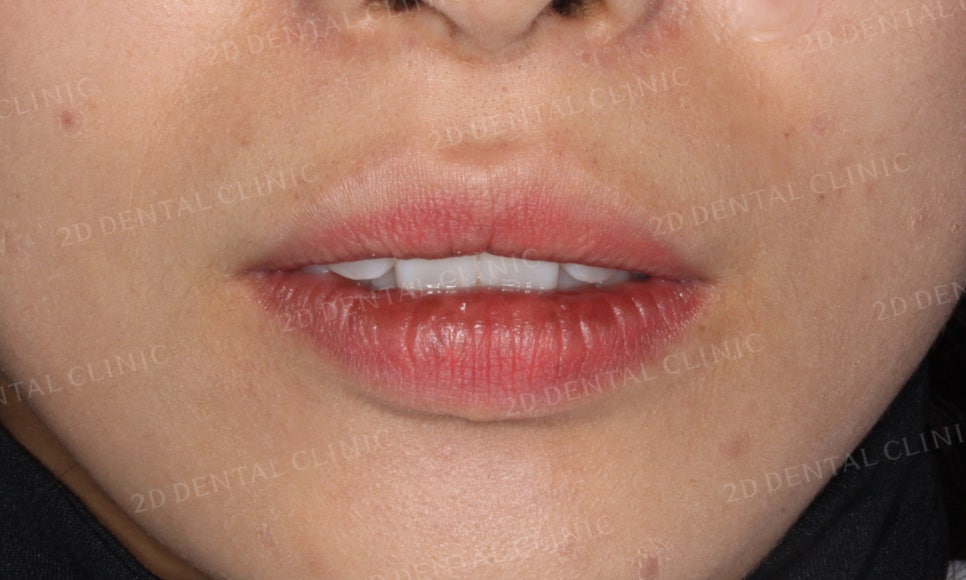 [부분교정] 틀어진 앞니, 부분교정으로 앞니교정하기! by.투디치과(2D치과) 관련 이미지 2