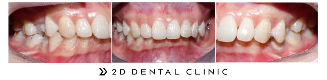 과개교합 케이스도 2D치과에서 해결! 관련 이미지 5