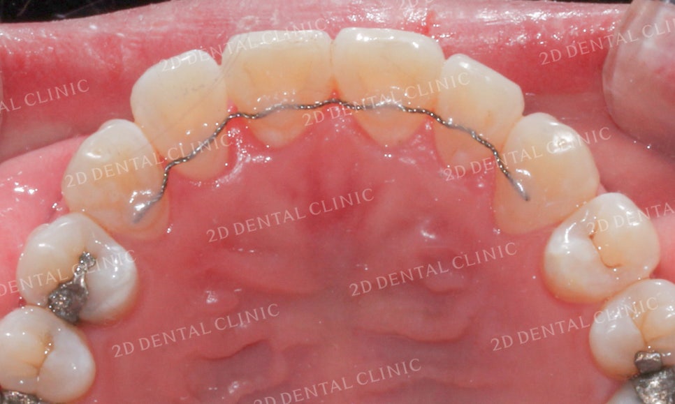 [앞니교정]부정교합교정, 부분교정으로 완성하기! by.투디치과(2D치과) 관련 이미지 16