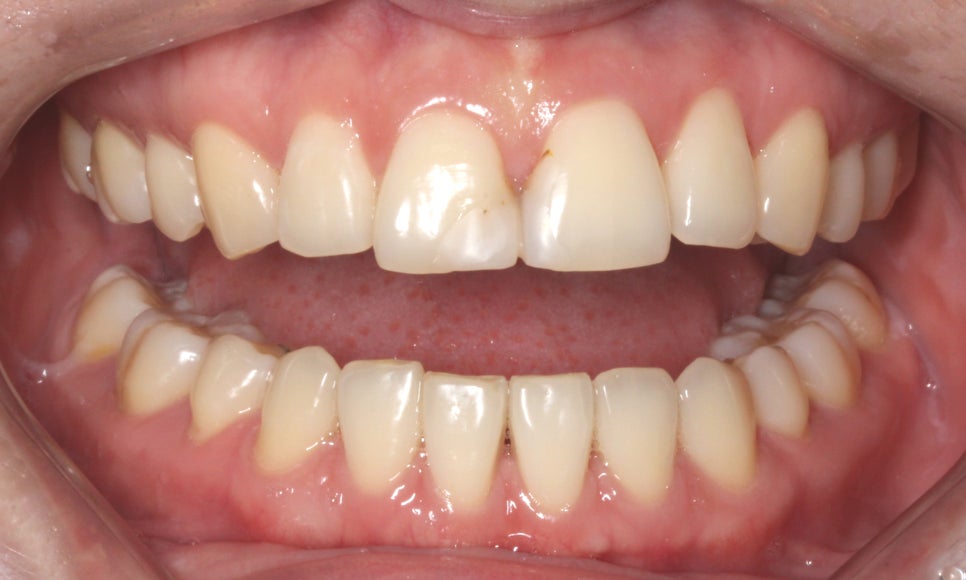 평생 소장! 앞니보철은 자연스러운 2D치과(투디치과) BLINX(블링스)로! 관련 이미지 2