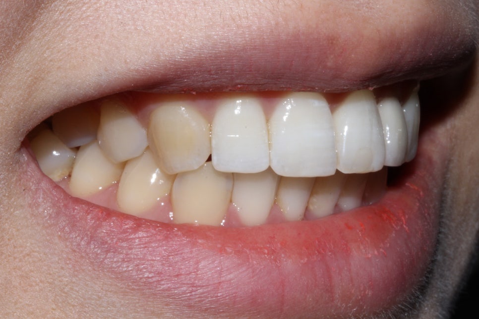 왜소치 뻐드렁니 교정 신논현역치과에서 관련 이미지 10