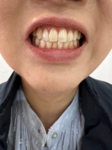 무삭제라미네이트 블랙필름 케이스 비포 에프터 후기 관련 이미지 10