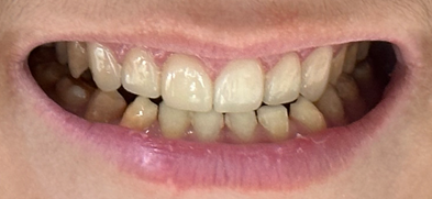 무삭제 라미네이트 개인의 치아디자인에 맞춘 단 하나밖에 없는 치아디자인 블랙필름 관련 이미지 4