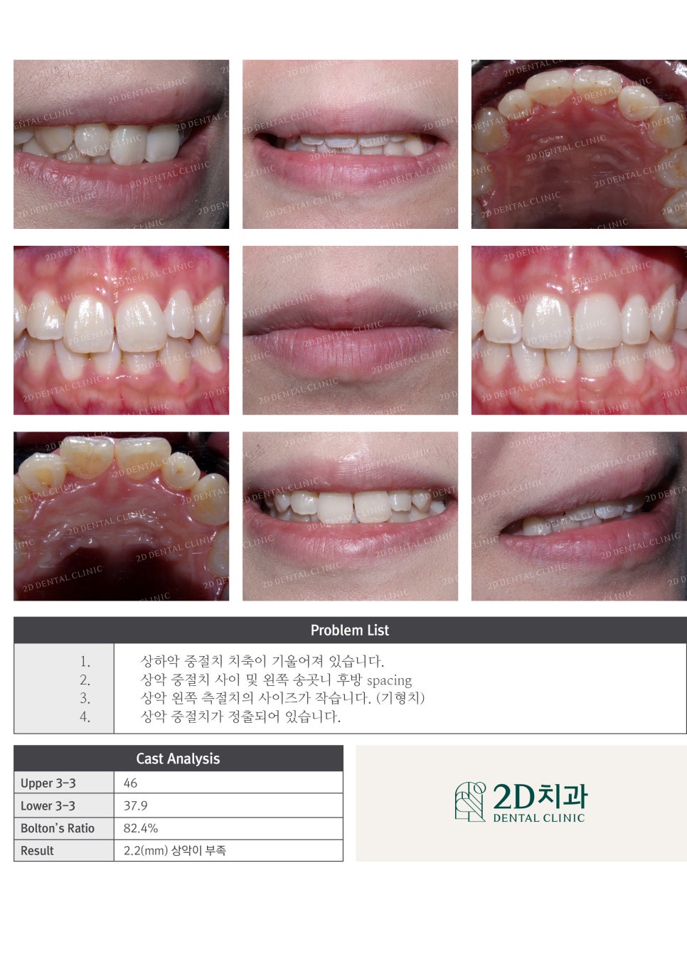 나비치아교정, 부분교정으로 나비치아 탈출하기! by.투디치과(2D치과) 관련 이미지 7