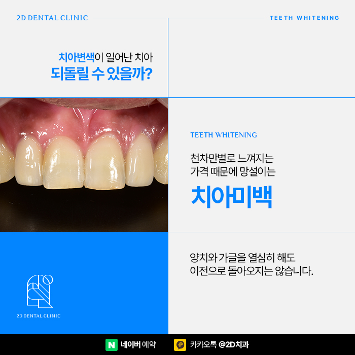 치아미백 가격, 비용 걱정 없이 진행하려면, 신논현 치아미백 치과 관련 이미지 4