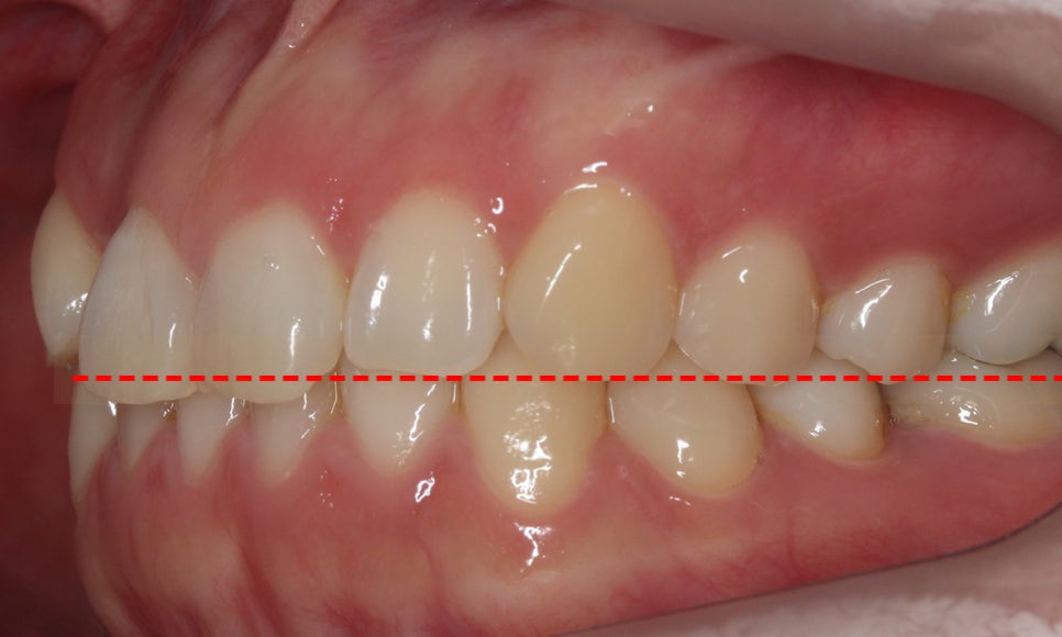 덧니교정 2D교정 (부분교정) 후기 관련 이미지 4