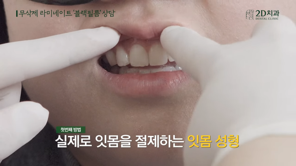 [블랙필름 상담받고 왔어요] #3 앞니가 깨졌어요 관련 이미지 7