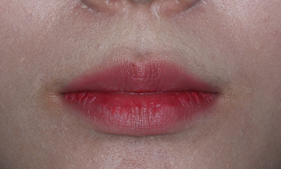 나비치아교정, 부분 치아교정으로 하고 싶다면? by.투디치과(2D치과) 관련 이미지 2