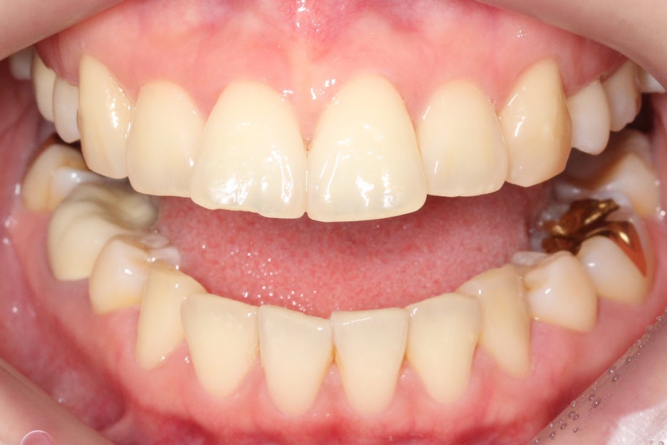 토끼앞니교정 부분교정으로 단기완성 관련 이미지 2