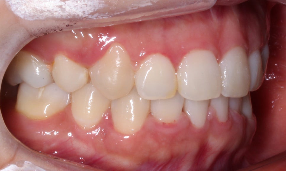 역삼역치과 송곳니덧니 crowding Case 관련 이미지 11