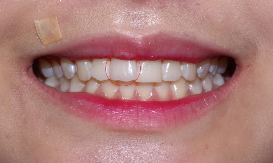 반포치과 뻐드렁니교정 방법은? 관련 이미지 2