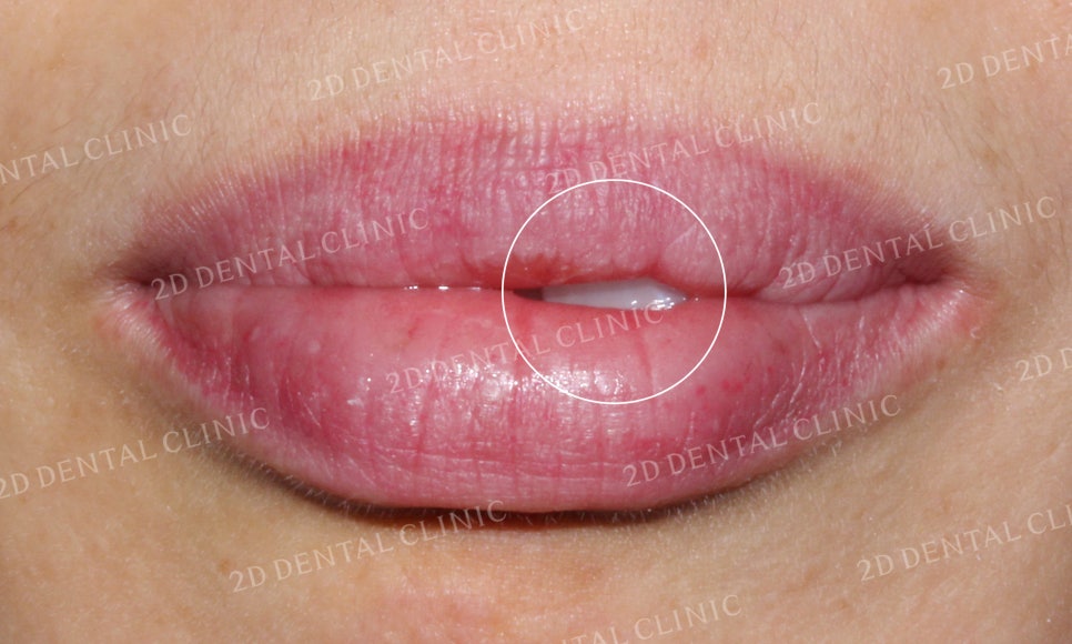 [앞니교정] 돌출앞니교정, 토끼앞니를 클리피씨교정으로 완성하기! by. 투디치과(2D치과) 관련 이미지 2