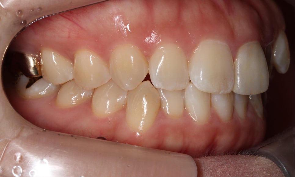 양악교정 송곳니교정 중심으로 관련 이미지 4