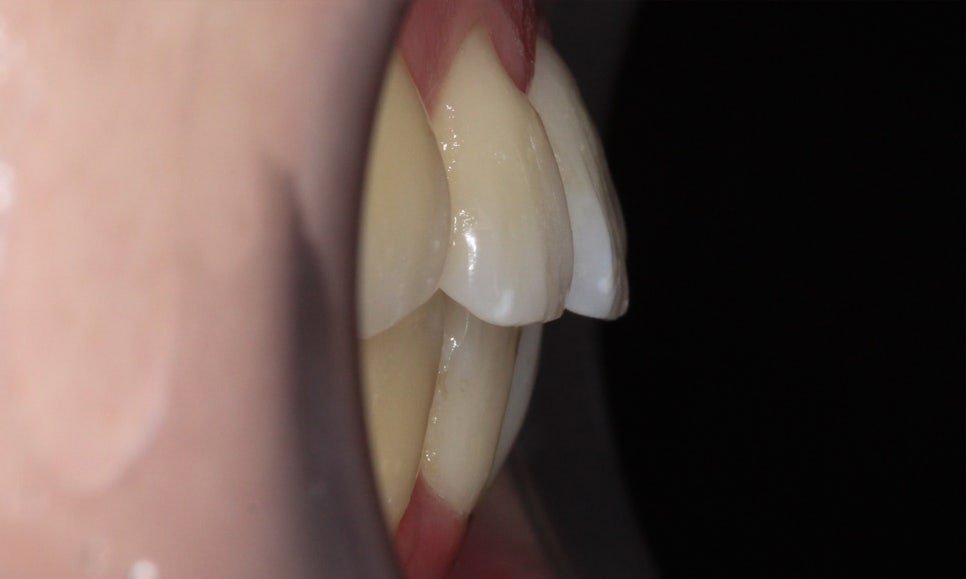 입툭튀 교정 신논현역치과 전체교정으로 관련 이미지 10