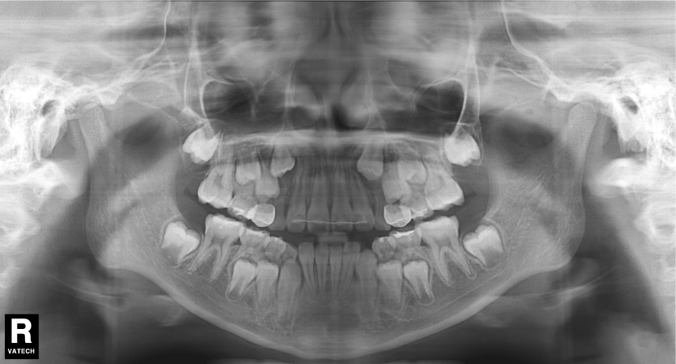 어린이 반대교합 덧니 교정으로 교정 끝! by. 투디치과(2D치과) 관련 이미지 3