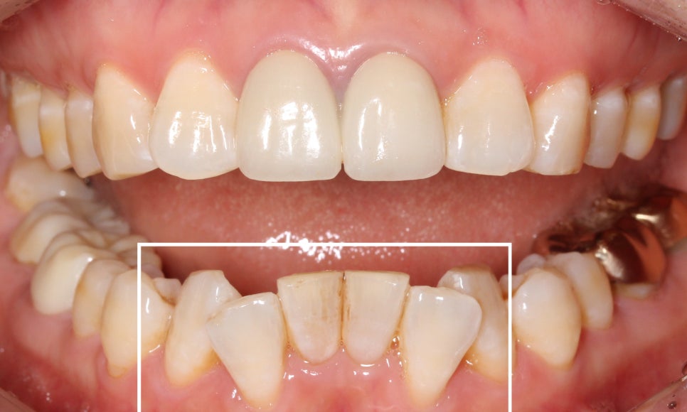 2D교정으로 아랫니 부분교정 빠르게 완성하기! 관련 이미지 4