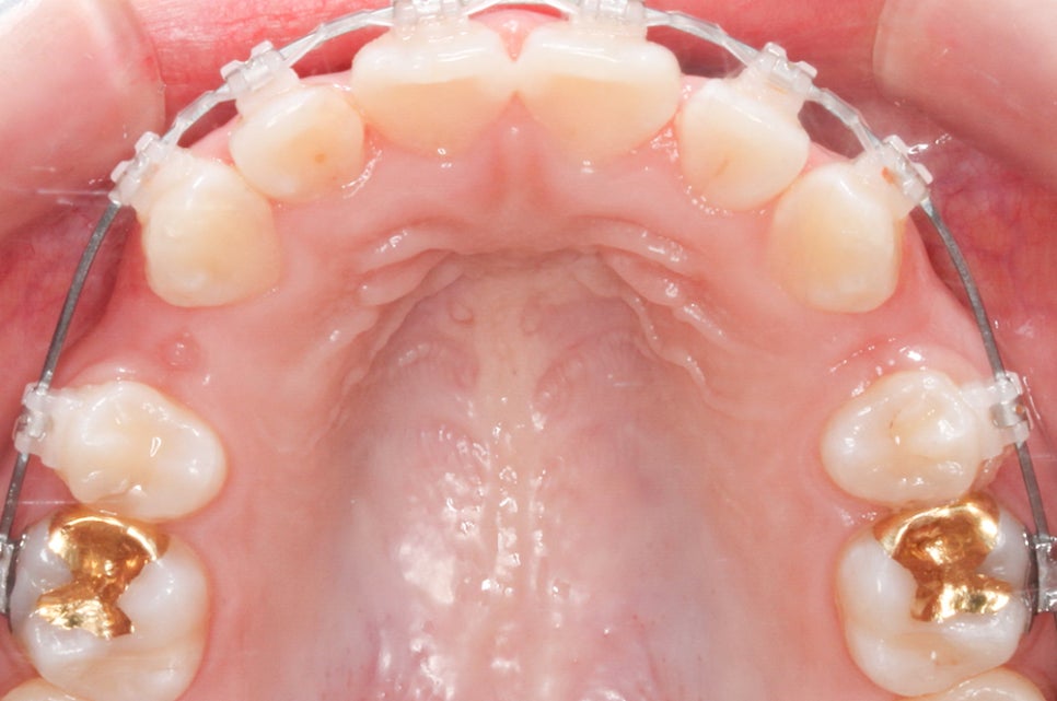 [돌출입 무턱] 안모교정 진행중! by.투디치과(투디치과)전체교정 관련 이미지 7