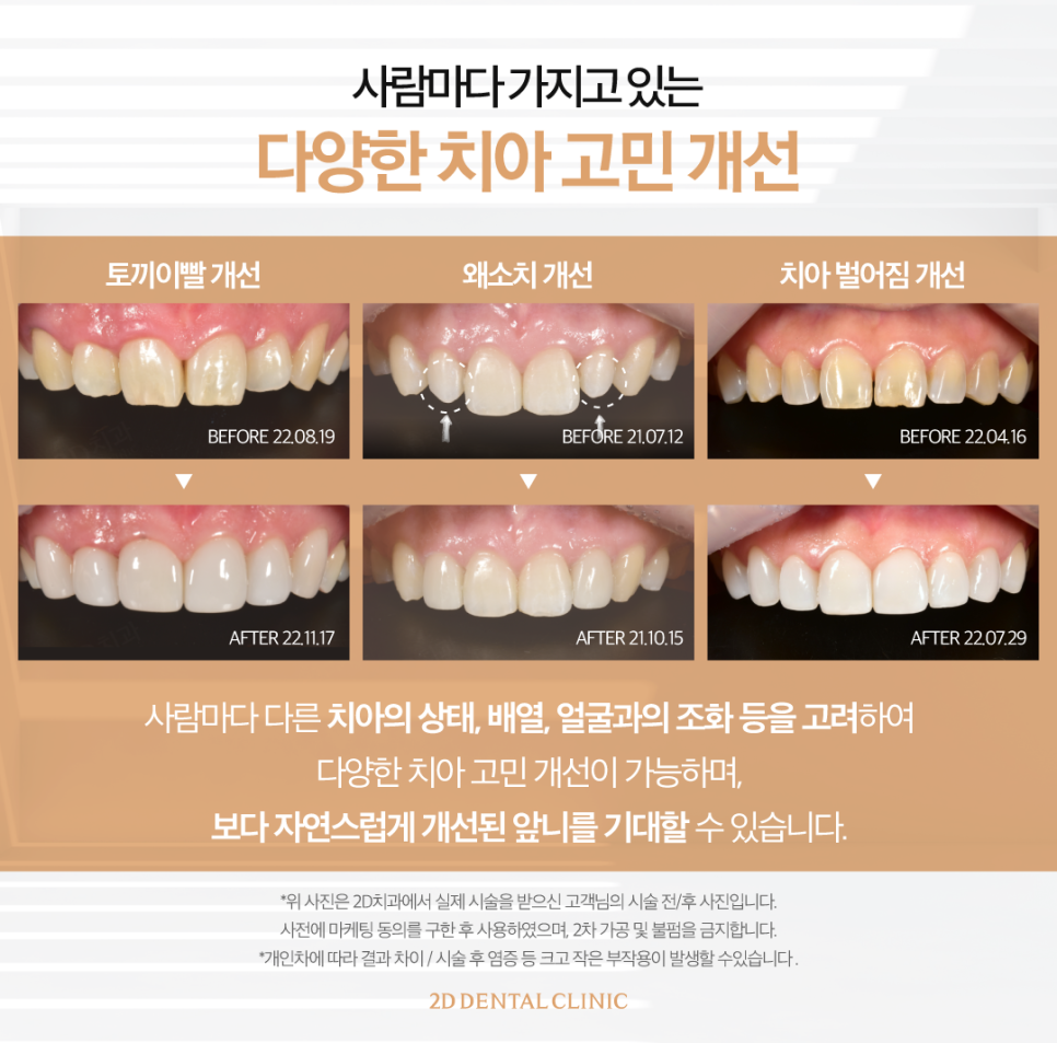 토끼이빨라미네이트 앞니심미치료로 자신 있게 웃어보세요! 관련 이미지 6