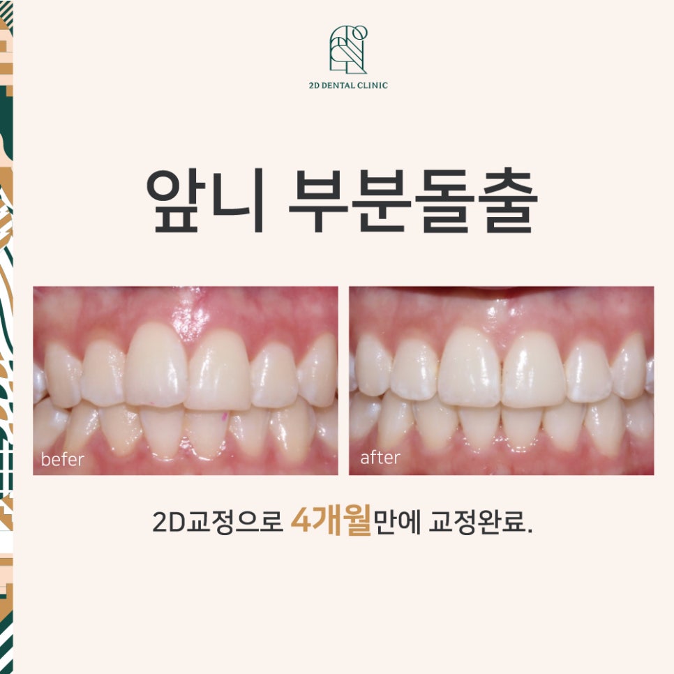 2D치과(투디치과) "앞니 부분돌출" 2D교정으로 완료 관련 이미지 1