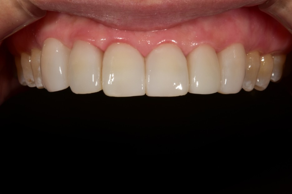 [투디치과] 블랙필름(비스포크) 치료의 다양한 사례 관련 이미지 9