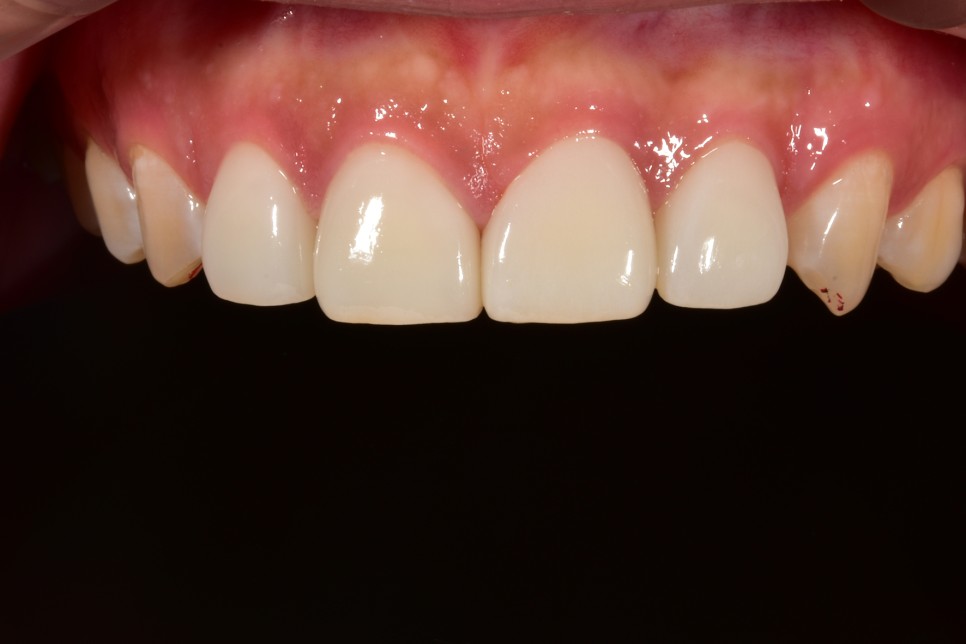 [투디치과] 블랙필름(비스포크) 치료의 다양한 사례 관련 이미지 13