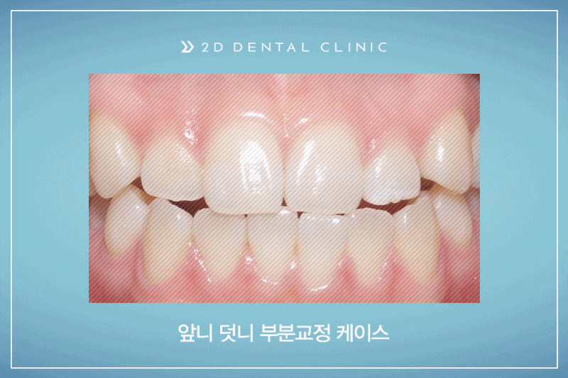 절단교합 교정 케이스 전후비교, 교정전문 2D치과 관련 이미지 1
