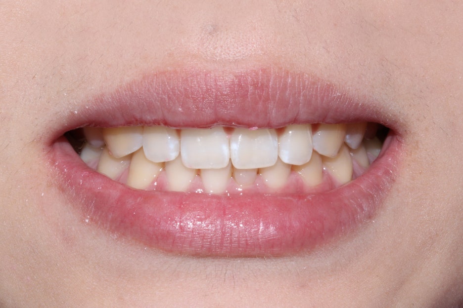 벌어진앞니 치간이개 공간 삭제하기! 관련 이미지 6