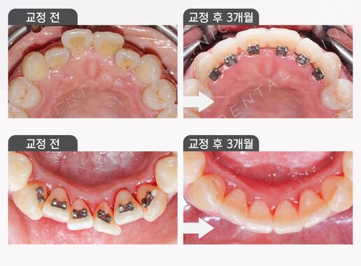 강남역치과[투디치과]투디교정/앞니교정 관련 이미지 2