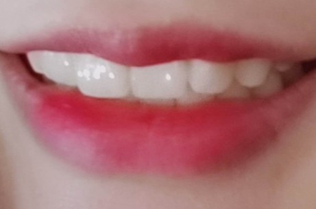 치아성형 잇몸성형 치아삭제 없는 무삭제라미네이트 블랙필름 관련 이미지 6