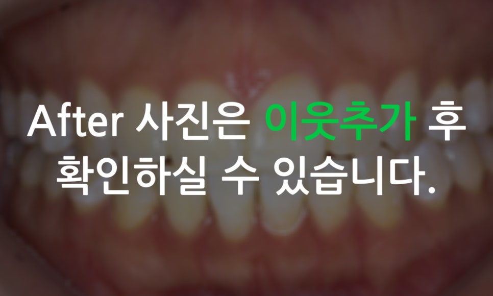 앞니돌출 급속교정 Case feat. 2D교정 관련 이미지 8