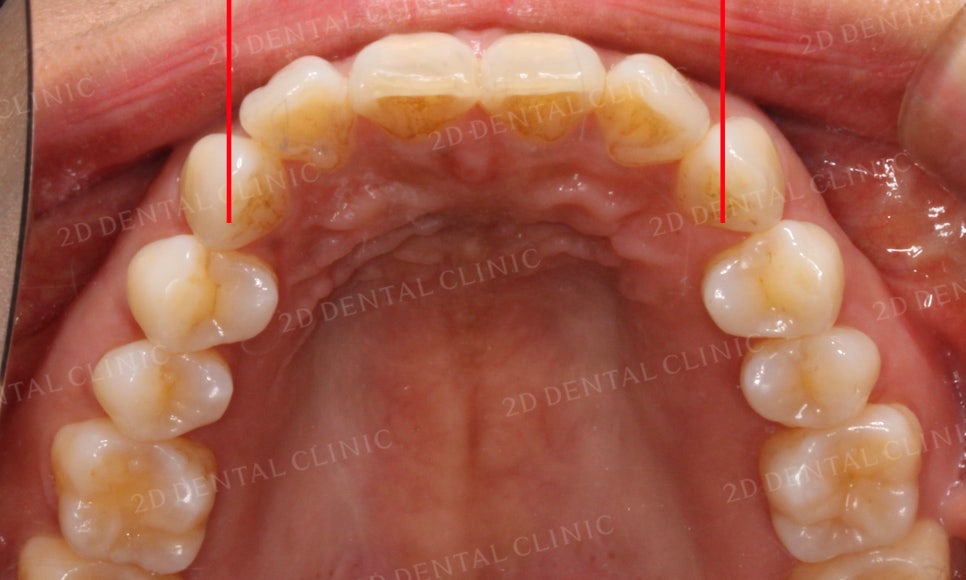 [부분교정] 틀어진 앞니, 부분교정으로 앞니교정하기! by.투디치과(2D치과) 관련 이미지 8