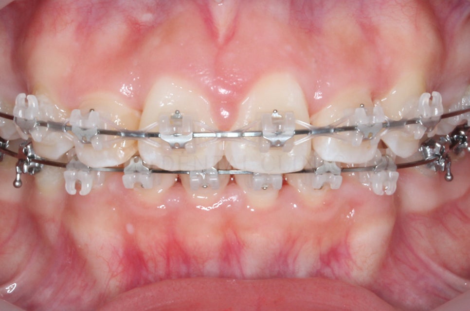 [돌출입 무턱] 안모교정 진행중! by.투디치과(투디치과)전체교정 관련 이미지 8