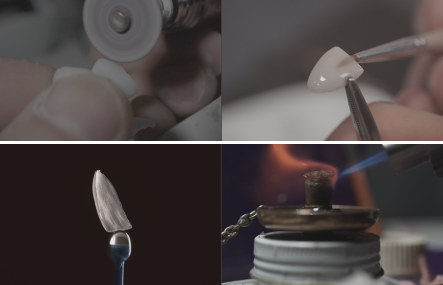 앞니라미네이트 치아삭제없는 무삭제라미네이트 블랙필름 관련 이미지 6