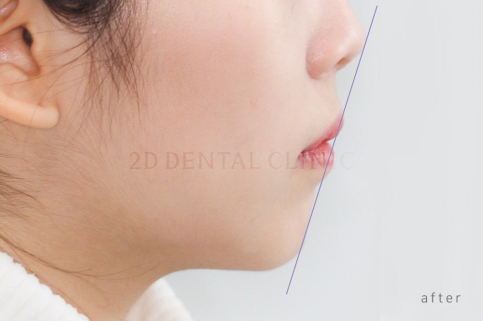 [돌출입 무턱] 안모교정 진행중! by.투디치과(투디치과)전체교정 관련 이미지 10