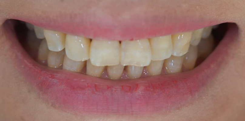 치아변색 개선은 무삭제라미네이트 블랙필름 관련 이미지 3