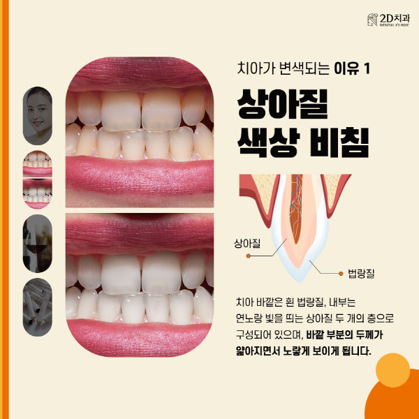 치아착색음식 때문? 양치해도 치아가 누런 이유 관련 이미지 2