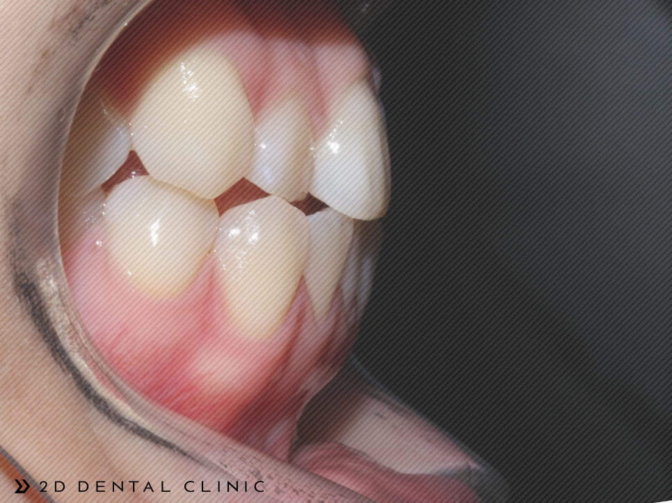 절단교합 교정 케이스 전후비교, 교정전문 2D치과 관련 이미지 12
