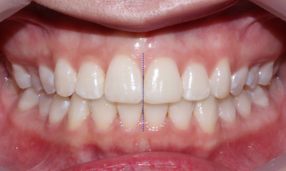반포치과 뻐드렁니교정 방법은? 관련 이미지 10