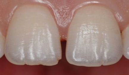 앞니충치 무삭제라미네이트비용 블랙필름 관련 이미지 5