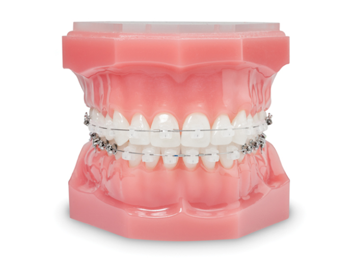 [투디(2D)치과] 데이먼 클리어 교정에 대해 알아보자! 관련 이미지 1