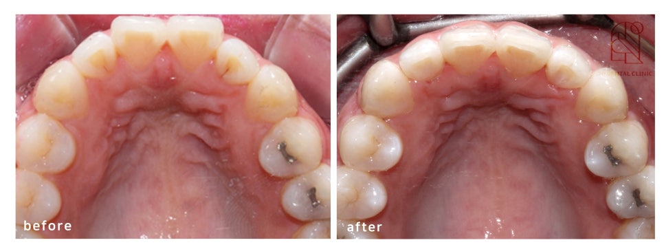 2D치과(투디치과)교정일기 ㅣ 연예인이 많이하는 2D교정 토끼이빨 case 관련 이미지 3