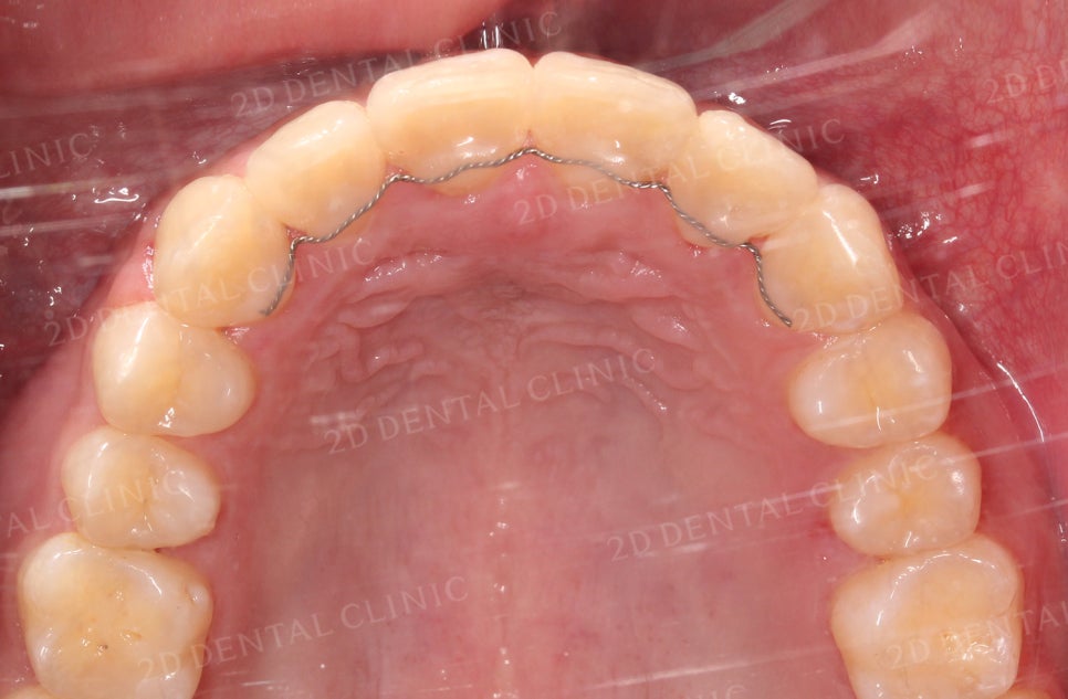 [앞니교정] 토끼앞니교정, 클리피씨 교정으로 완벽하게! by.투디치과(2D치과) 관련 이미지 17