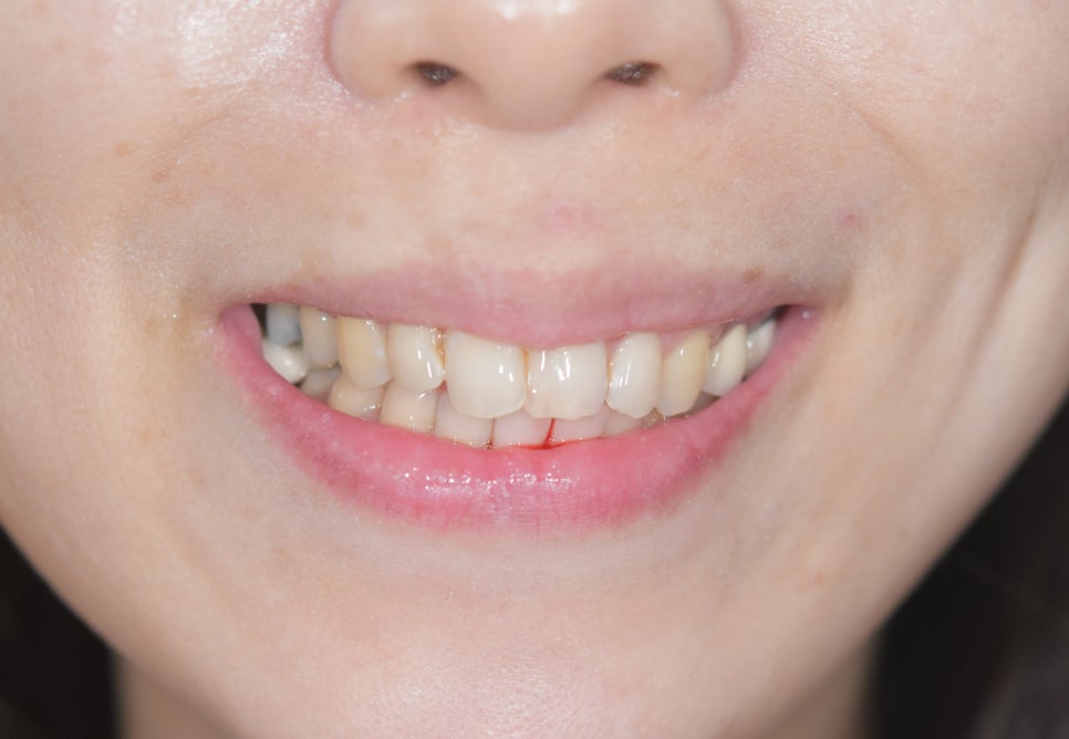 라미네이트치과 알아본다면? 관련 이미지 6